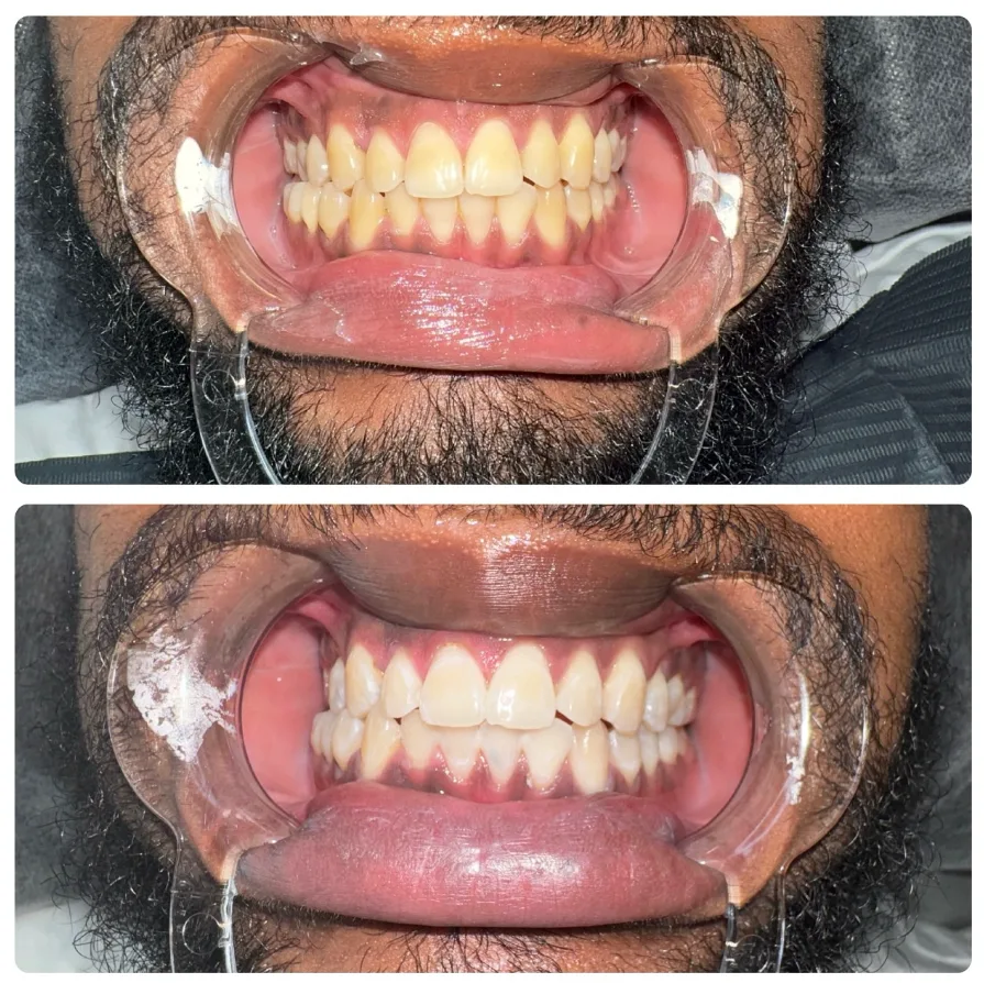 A bright smile after a Lumen whitening session