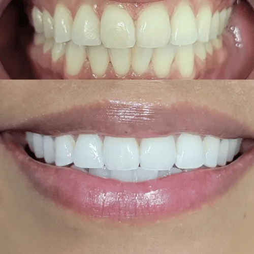 A bright smile after a Lumen whitening session