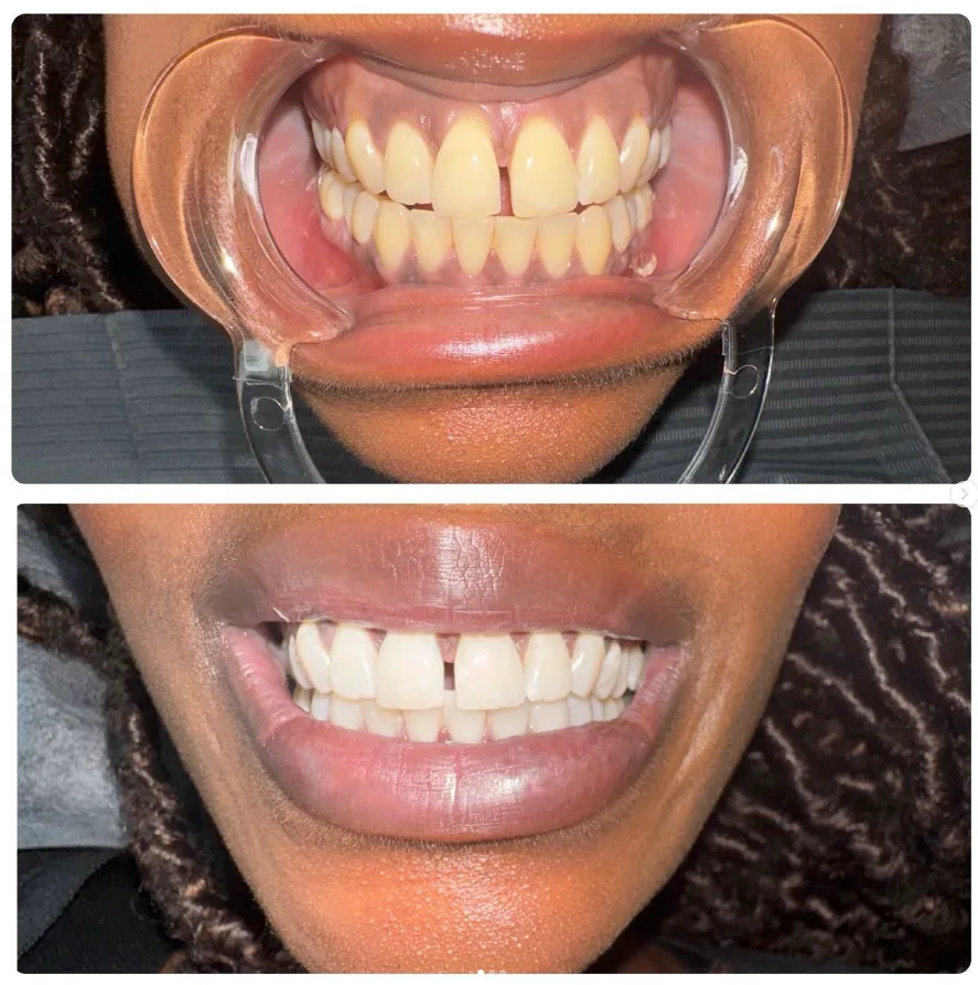 A bright smile after a Lumen whitening session