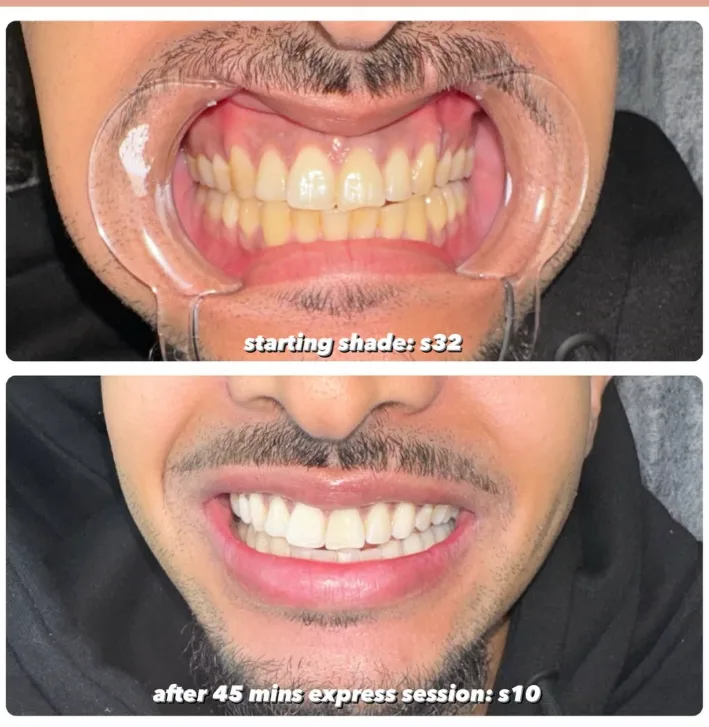 A bright smile after a Lumen whitening session