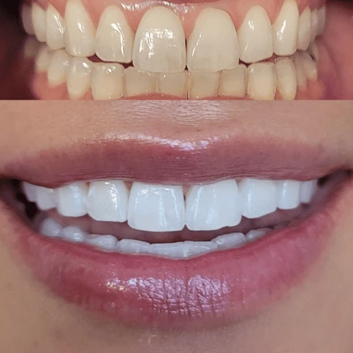 A bright smile after a Lumen whitening session
