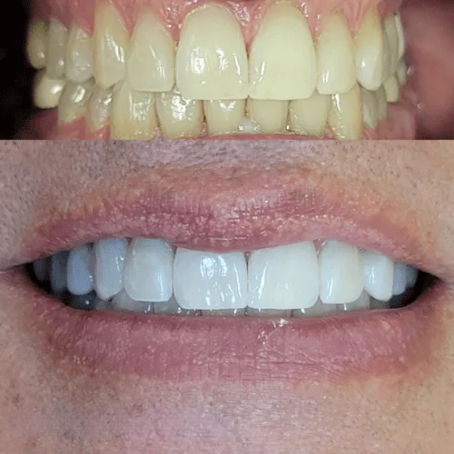 A bright smile after a Lumen whitening session